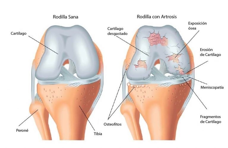 Artrosis rodilla